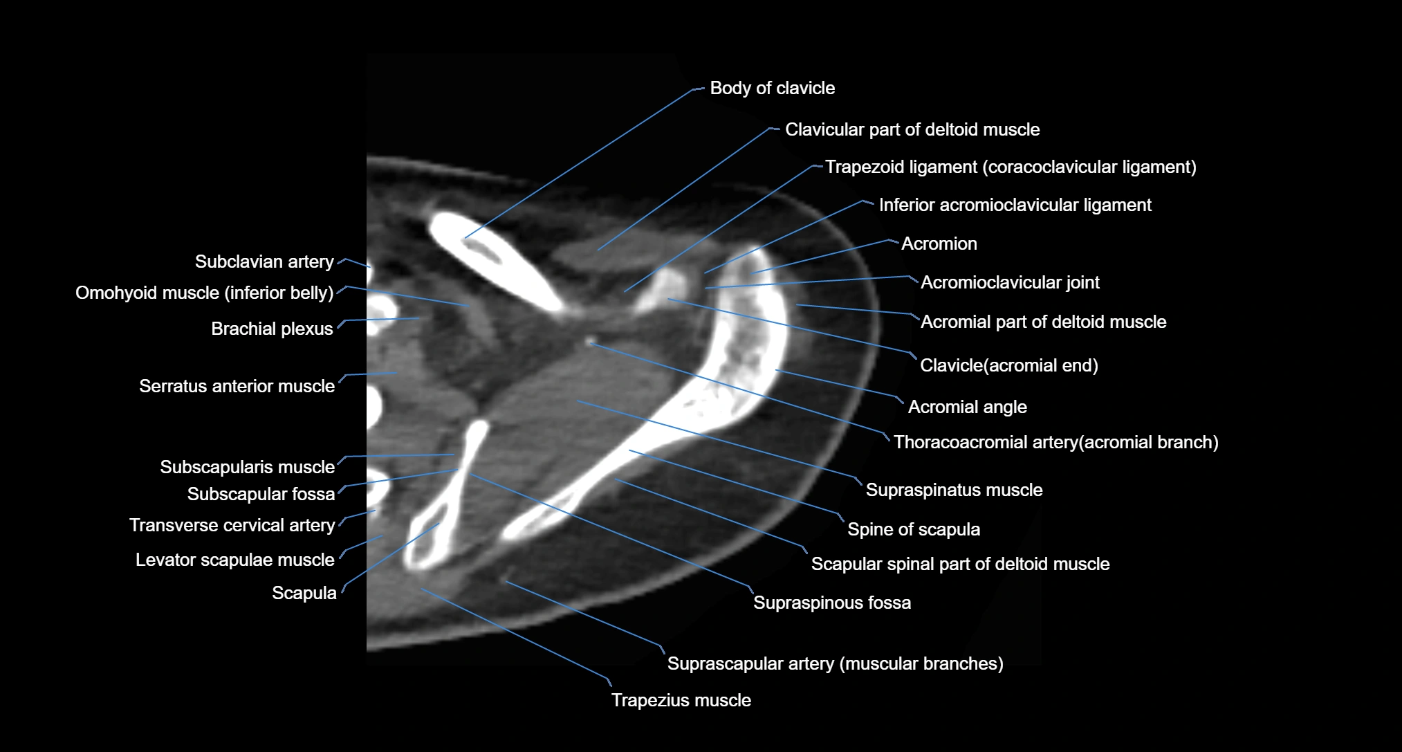 CT Shoulder axial cross sectional anatomy labelled radiology image -00017.webp